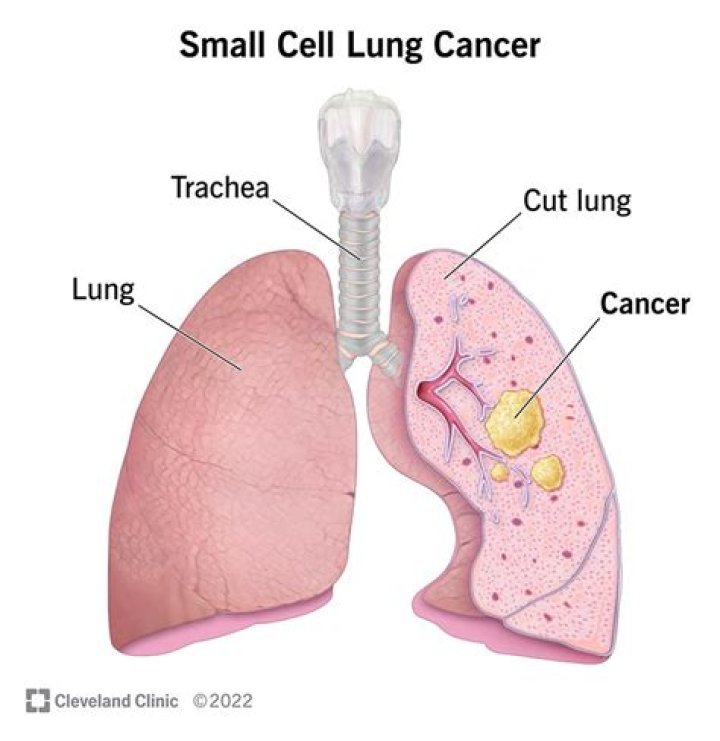 When did my mother die of lung cancer?
